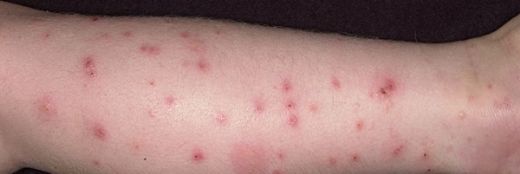 Bebeklerde Sinek Isırığı Belirtileri ve Tedavisi